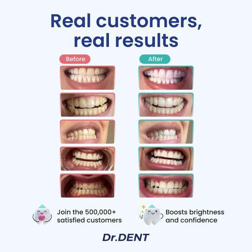 🦷 
Kit de Blanchiment des Dents Portable à LED – Usage à Domicile & en Voyage